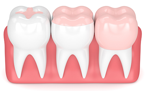 Couronne dentaire Orange - Esthétique dentaire - Dentiste Orange
